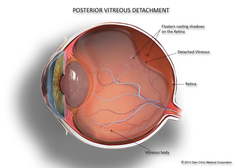posterior vitreous detachment floaters